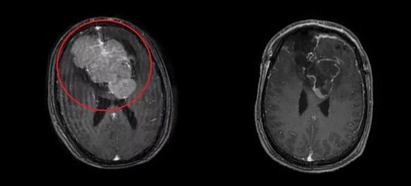 被稱為大腦“拆彈”專家！從醫27年，廣東這位醫生完成超1萬例顱腦手術！