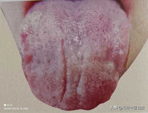 腹痛、中虛髒寒的舌象