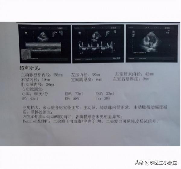 闢謠！冠心病好轉後就不用吃藥了嗎？有多少人因此放了心臟支架