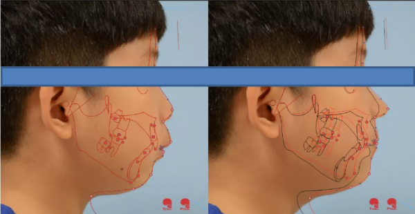 娃睡覺張嘴越長越醜？很多小孩都有的腺樣體肥大，一文說清