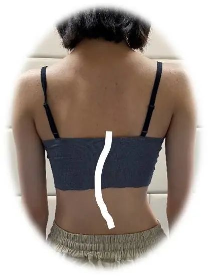 簡單辨別脊柱側彎,避免孩子走“彎”路 簡單辨別脊柱側彎,避免孩子走“彎”路