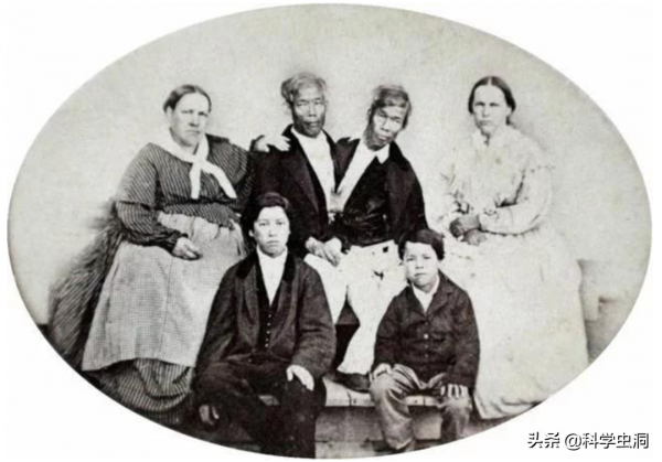 連體人一個去世怎麼辦？連體姐姐死後，妹妹被迫和遺骸生存2天