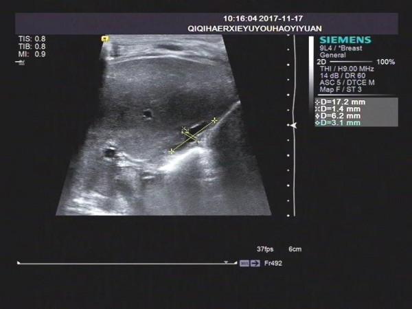 淺析幼兒黃疸之膽道閉鎖的超聲表現