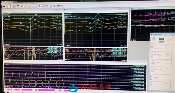 徐醫附院臨床電生理團隊成功開展首例術中神經電生理監測技術