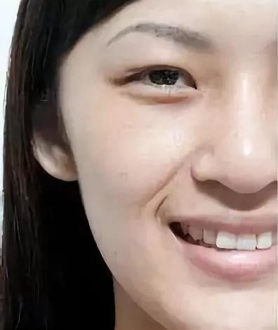 韋敏科普丨哪些原因會導致法令紋出現 韋敏科普丨哪些原因會導致法令紋出現