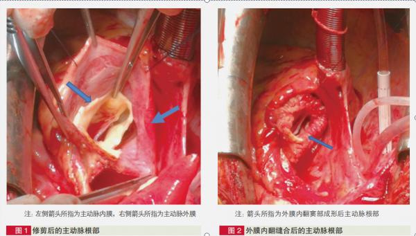 手術治療Stanford A 型主動脈夾層有新方法!阜外深圳醫院研究 手術治療Stanford A 型主動脈夾層有新方法!阜外深圳醫院研究