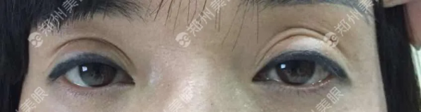 為何你的雙眼皮會出現上瞼後退性加寬？