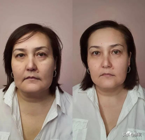 嘴角下垂對面容的影響有多大？