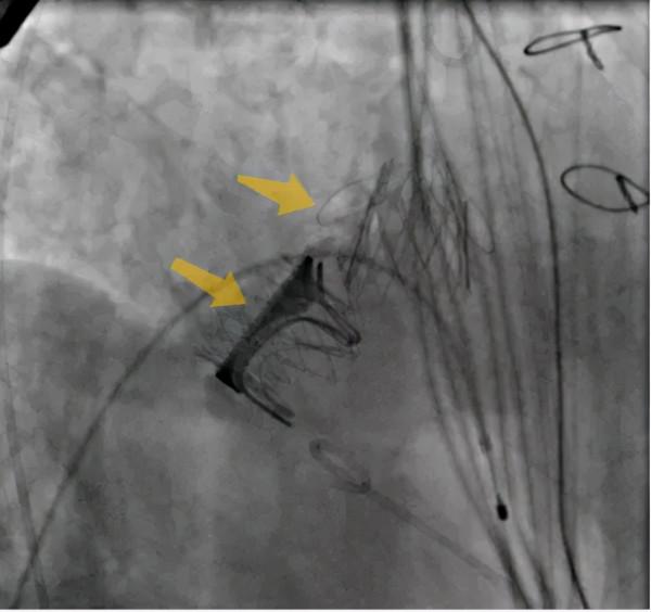 中秋假期,老人心臟生物瓣膜衰敗生命垂危,多學科團隊新技術成功巧換“心門” 中秋假期,老人心臟生物瓣膜衰敗生命垂危,多學科團隊新技術成功巧換“心門”