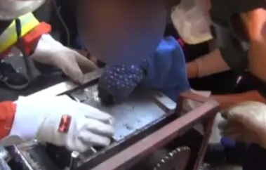 河南43歲女工捲入絞肉機，右手斷成9節，醫生苦撐17小時為其接上