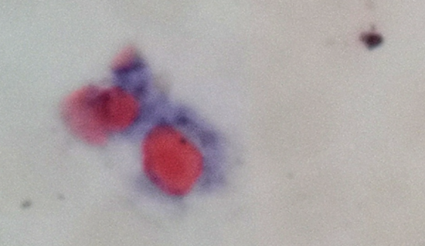 一例慢性中性粒細胞白血病病例分享