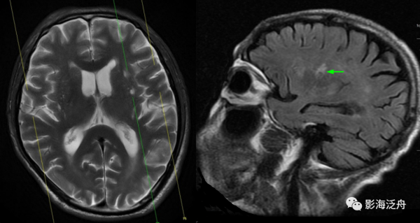 VR腔隙、腔梗灶、微出血、脫髓鞘，傻傻分不清？快看這裡