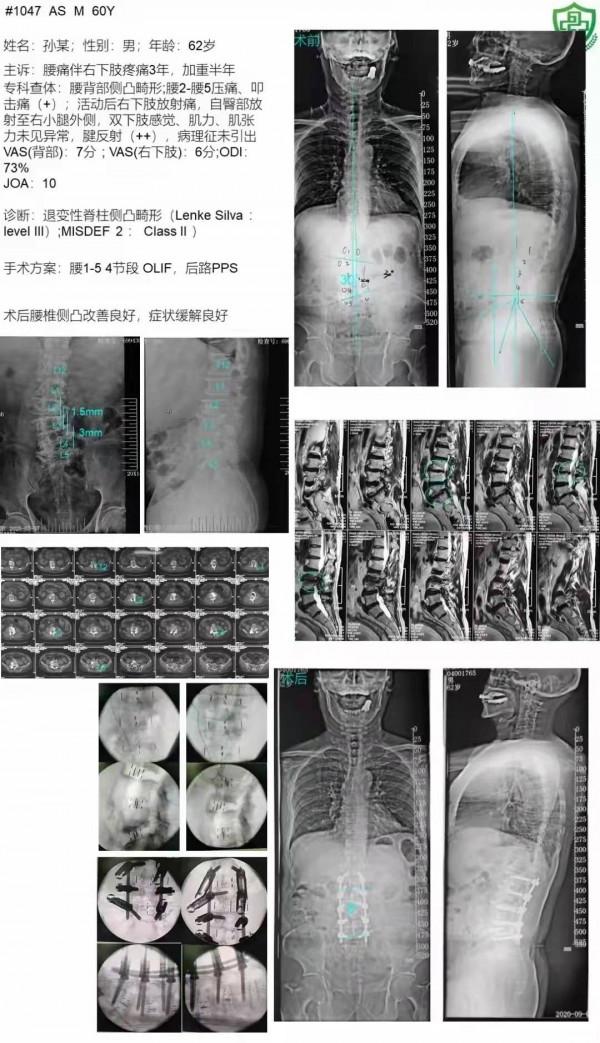 腰椎後凸畸形是怎麼回事？這種情況嚴重嗎？需要手術嗎？