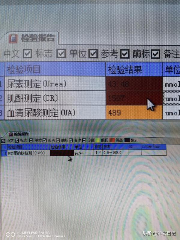 29歲男子從發現泡沫尿到尿毒症僅3年，醫生：只因忽視了這3點