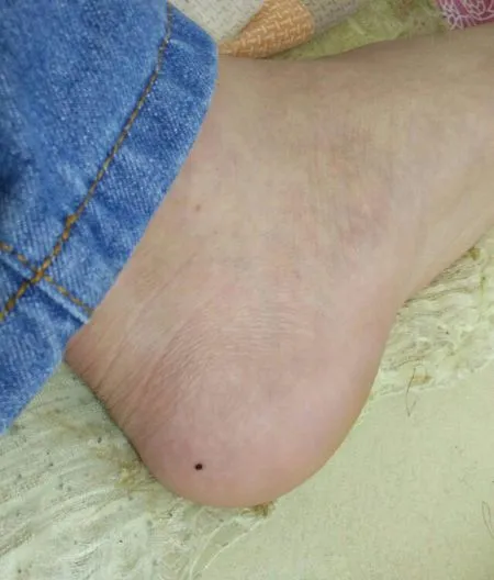 身體出現這樣的痣,可能是癌細胞“在試探”,快看你有沒有! 身體出現這樣的痣,可能是癌細胞“在試探”,快看你有沒有!