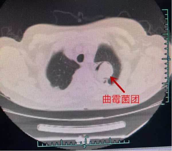 反覆咳嗽10多年,原來是肺發黴了,這種致病菌在自然界";存在感";很強 反覆咳嗽10多年,原來是肺發黴了,這種致病菌在自然界";存在感";很強