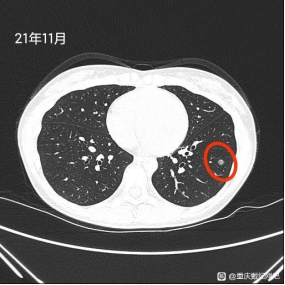 &OpenCurlyDoubleQuote;六年的感情因結節而退縮&rdquo;同行患磨玻璃肺癌心酸求助