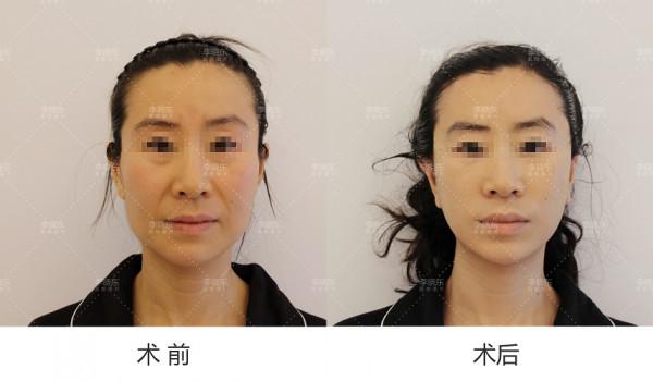 「53歲的趙女士」PSV面部提升術後30天，親身經歷解答大家的疑問