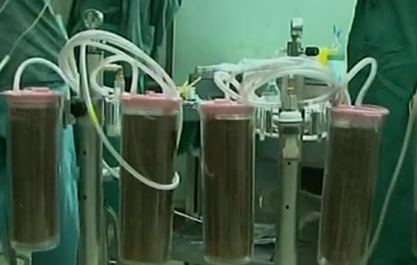 還記得那個得“怪病”肚子大過孕婦的山西女童嗎？後來治好了嗎？