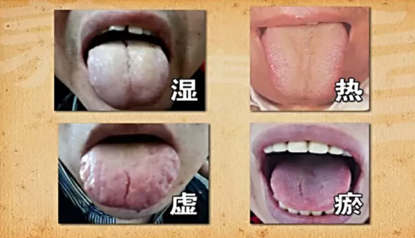 2步看出胃部問題，有這4種舌象的人要小心了
