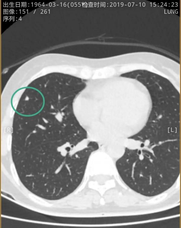 右肺多發實性結節2年多了，我們該怎麼看待？