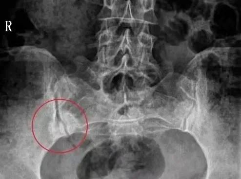 容易被誤診的“腰痛”——骶髂關節炎