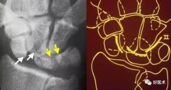 贊！腕關節X線高畫質解剖+腕骨脫位典型病例