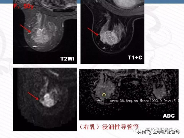 乳腺T2WI高訊號腫瘤病變的診斷思路 乳腺T2WI高訊號腫瘤病變的診斷思路