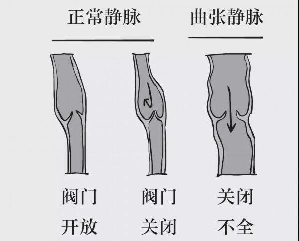 靜脈曲張？中醫：送你7味中藥，收縮血管，血活則通
