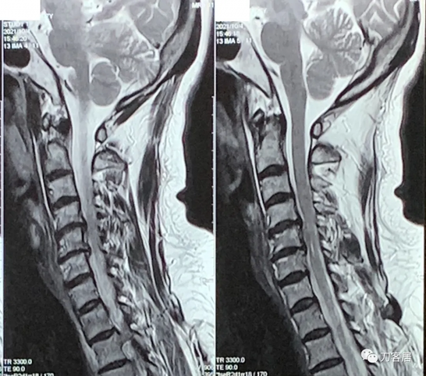 查體的重要性，一直按照腰椎間盤突出症治療的脊髓型頸椎病