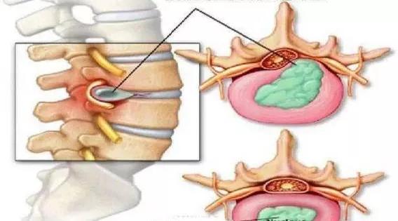 腰椎間盤突出知多少? 腰椎間盤突出知多少?