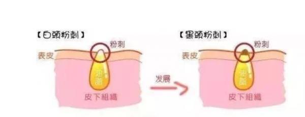 建議有“閉口”的女生，堅持做好這幾件事，高效解決不反覆