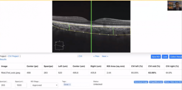 COVID-19眼部感染，何為真？何為假？丨APVRS 2021