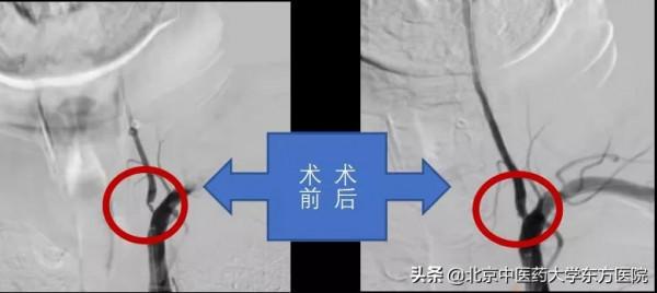 【醫學小常識】有一種眩暈需要格外注意