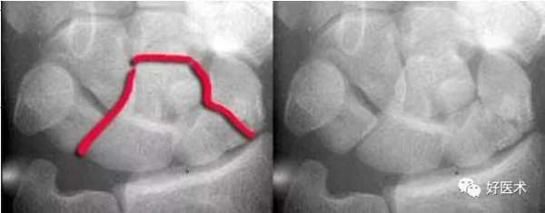 贊！腕關節X線高畫質解剖+腕骨脫位典型病例