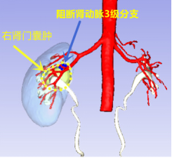 湘雅二醫院泌尿外科專家慧眼辯“囊”，精準除瘤，高選保腎