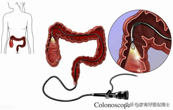 最常見5類息肉每個人都可能有，哪些無癌變風險，哪些需要切除？