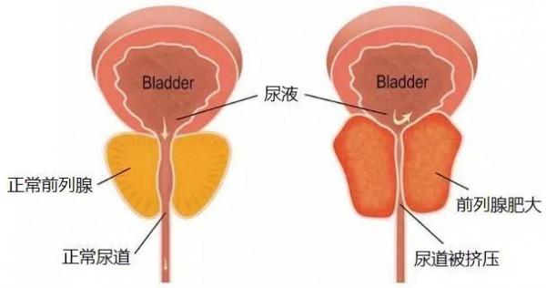 【老來夜尿、尿頻，什麼原因，怎麼應對？】