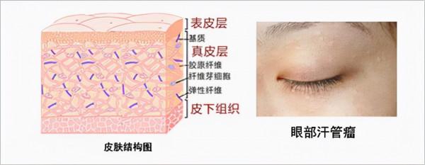 汗管瘤要怎麼治？