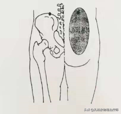 腰椎間盤突出，臀部疼痛、麻木，是怎麼回事？該如何治療