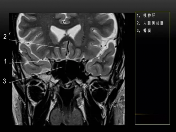 MRI下眼部及鼻竇解剖