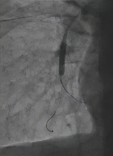 一個腸息肉切除小手術,發現更大致命“隱患” 一個腸息肉切除小手術,發現更大致命“隱患”