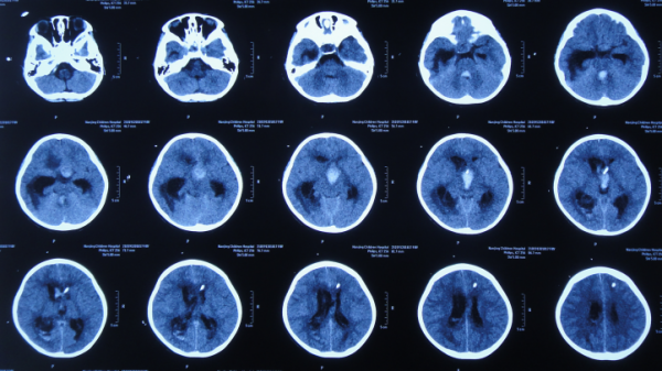顱內生殖細胞瘤切除術後腦積水仍反覆,意識模糊,左側肢體偏癱 顱內生殖細胞瘤切除術後腦積水仍反覆,意識模糊,左側肢體偏癱