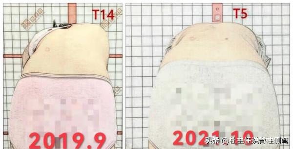 超過40度的脊柱側彎，是手術還是保守治療？