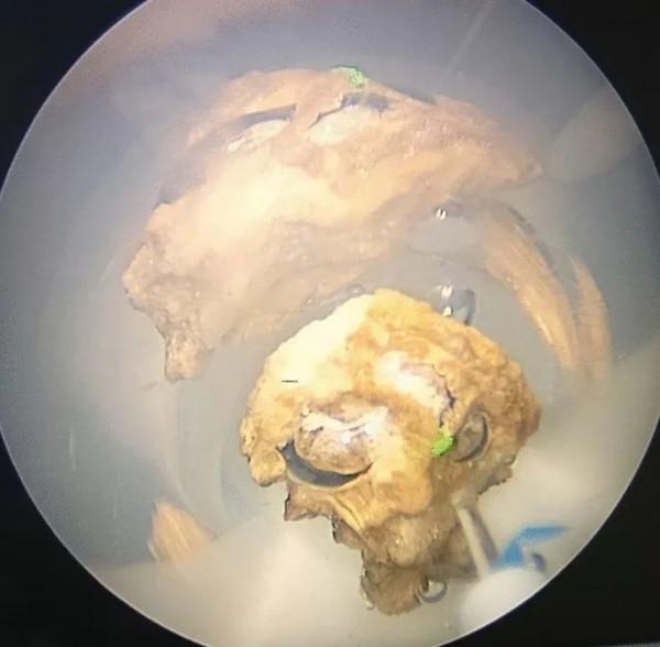 改變思維，就可能消除鐳射碎石粉塵引起的視野模糊？