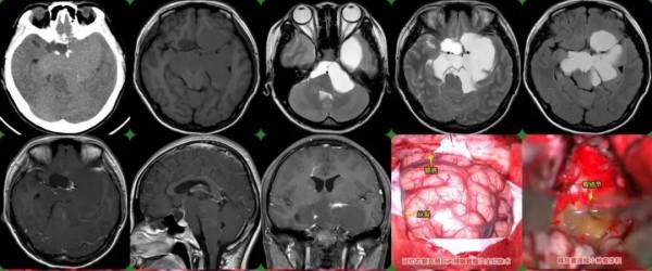 神經外科張永力:少兒頭痛、視力下降、長不高等,要警惕顱咽管瘤 神經外科張永力:少兒頭痛、視力下降、長不高等,要警惕顱咽管瘤