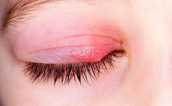 治療麥粒腫 艾灸後溪穴