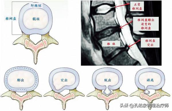 腰椎間盤突出後,該怎麼辦?如何選擇治療?請收藏 腰椎間盤突出後,該怎麼辦?如何選擇治療?請收藏