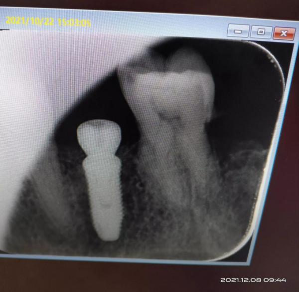 成功種上一顆牙