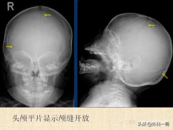 小兒顱縫早閉的診斷治療